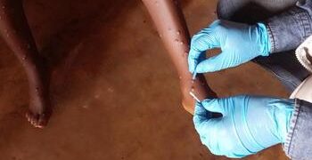 Mpox : l’OMS approuve le premier test de diagnostic pour une utilisation en situation d’urgence